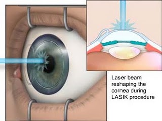 Los Angeles eye surgeon